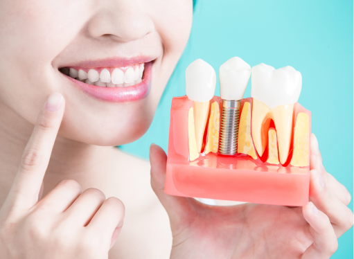 improving smile with dental implants